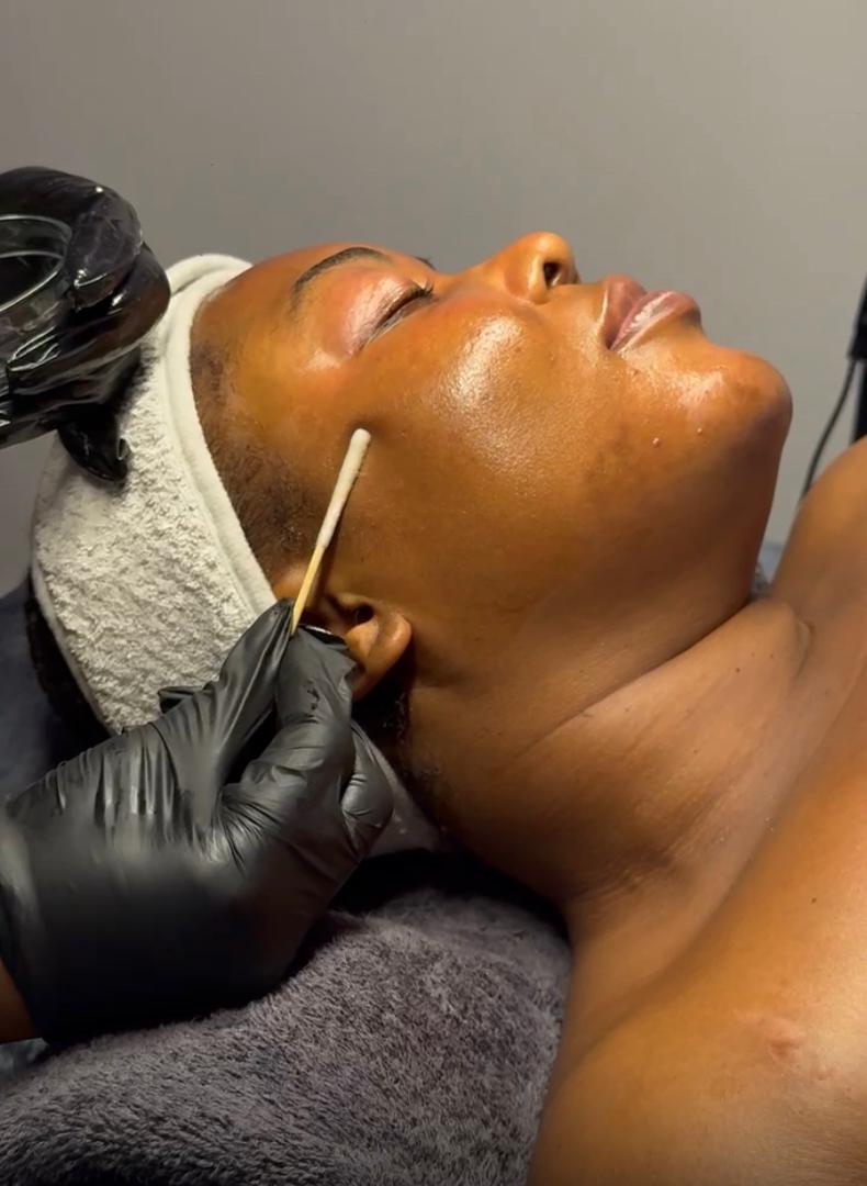 Chemical peels